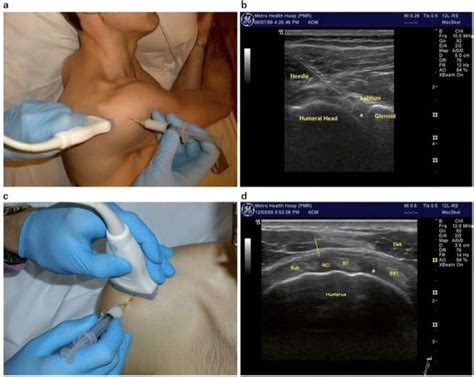 Ultrasound Guided Shoulder Joint And Bursa Injections NYSORA