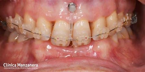 Microtornillos Ortodoncia Ortodoncia Lingual Con Microimplantes