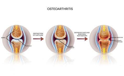 Great Toe Arthritis Correction | YEG Foot and Ankle Inc