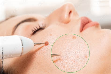 Electrocoagulation And Laser Cosmelotogy Dermatologist Surgeon Using A