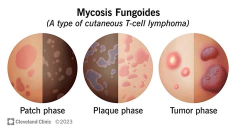 Micosi Fungoide Sintomi E Trattamento Sfomc