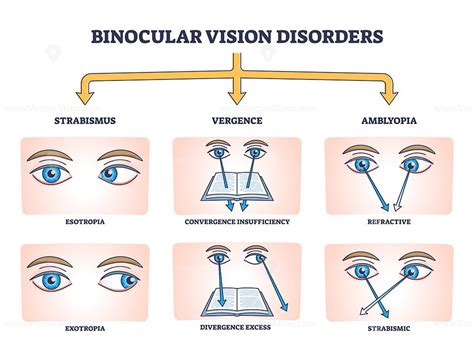 Binocular vision disorders with all eye defect examples outline diagram ...