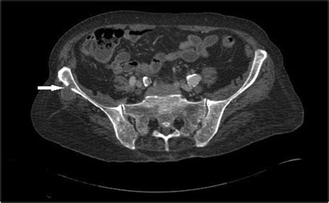 Axial computed tomography identifies a lytic destructive lesion of the ...