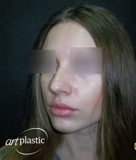 Ринопластика / Фото / Альбом №74 | Клиника Art-Plastic