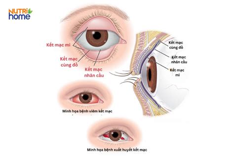 Kết mạc là gì? Cấu tạo, chức năng và các bệnh lý thường gặp