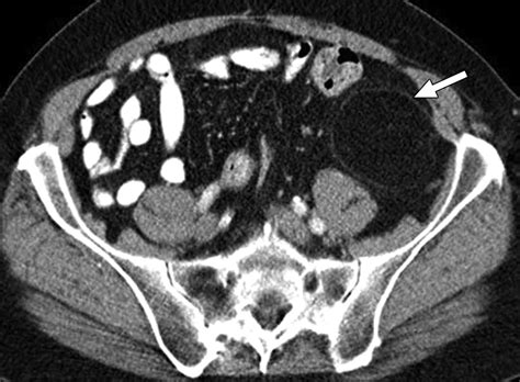 Imaging Of Liposarcoma Classification Patterns Of Tumor Recurrence