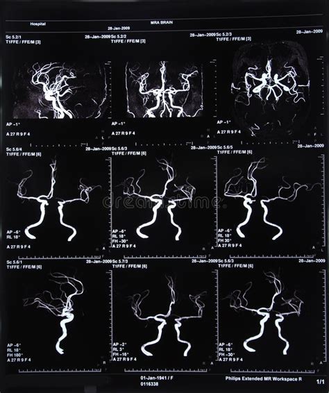 MRI scan image of brain stock photo. Image of anatomy - 34023878