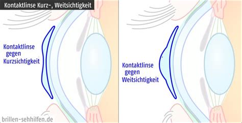 Kontaktlinsen Bei Weitsichtigkeit