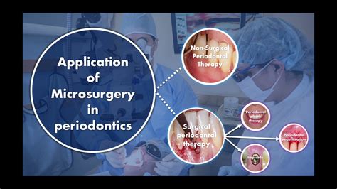 Periodontal Microsurgery YouTube