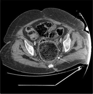 Fecal impaction - WikEM