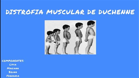 Distrofia Muscular De Duchenne V Deo Sistema Muscular Youtube