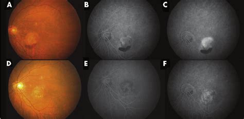 pretreatment fundus photograph   patient  subfoveal cnv