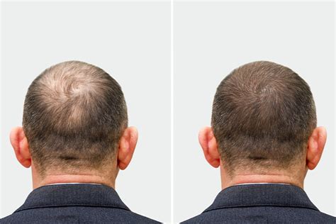 Hair Transplant Results After Six Months Vs One Year La Densitae