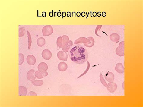 PPT La drépanocytose PowerPoint Presentation free download ID 5427177