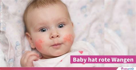 Baby Hat Rote Wangen Gr Nde Abhilfe Babyartikel De Magazin