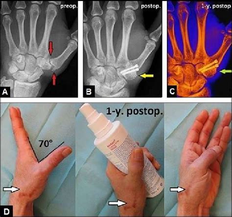 Figure 1 From Treatment Options For Thumb Carpometacarpal Joint Osteoarthritis With An Update To