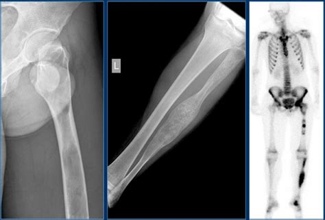 The Radiology Assistant Bone Tumor A G