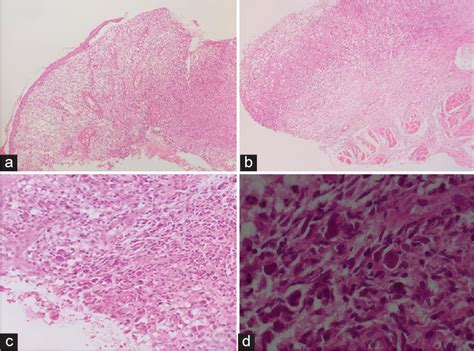 Epstein Barr Virus Positive Mucocutaneous Ulcer A Diagnostic