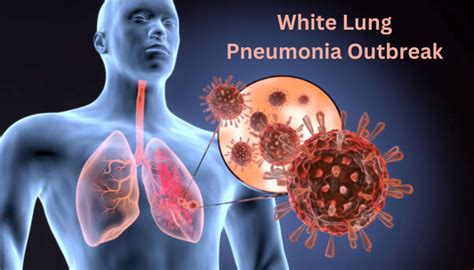 White Lung Pneumonia Outbreak A Comprehensive Analysis