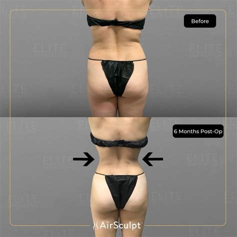 Elite Body Sculpture On Instagram “six Months After Her Stomach And Back Airsculpt Procedure