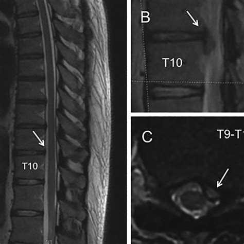 Initial Mri T2 Weighted Sagittal A Parasagittal B And