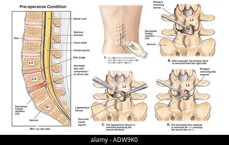 Back Surgery L5 S1 Disc Herniation with Laminectomy and Spinal Fusion ...