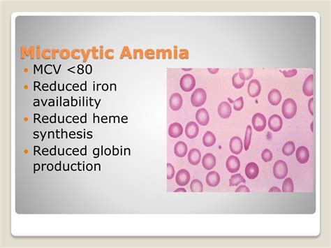 PPT - Anemia PowerPoint Presentation, free download - ID:5701423