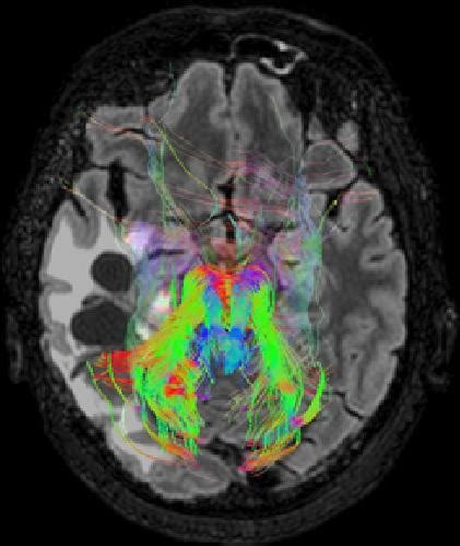 Parkinson S Disease Treatment Hifu Ultrasound Technology