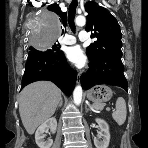 CECT coronal section. | Download Scientific Diagram