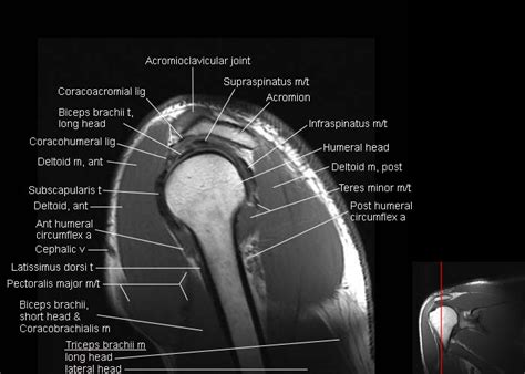 Sagittal Shoulder Mri Anatomy