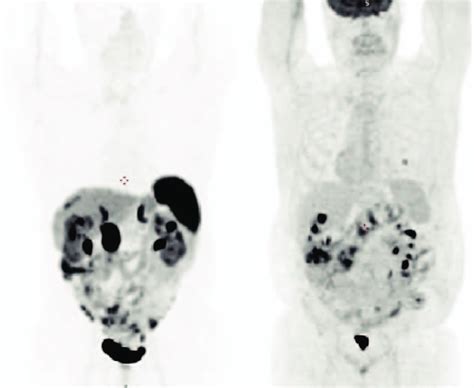 Maximum Intensity Projection Mip Of Ga Dotatoc Pet Ct Left And