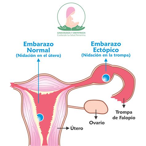 Infografía sobre Embarazo Ectópico Embarazo ectopico Embarazo