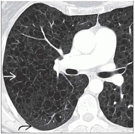 Lymphangioleiomyomatosis Radiology Key