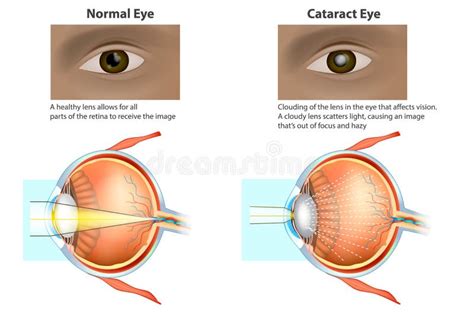 Cataract Symptomen Behandeling Geplaatste Lijnpictogrammen