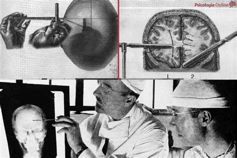 What Is Lobotomy And What Is It For