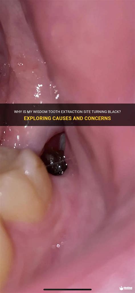 Why Is My Wisdom Tooth Extraction Site Turning Black Exploring Causes