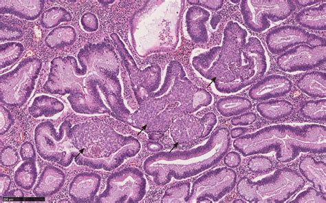 Tubular Adenoma Histology