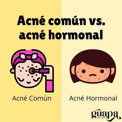 Acné Hormonal ¿qué Es Y Cómo Tratarlo Guapa Skincare