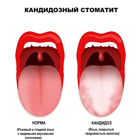 Кандидозный стоматит - симптомы острой и хронической форм, стадии и ...