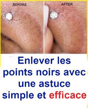 Enlever Les Points Noirs Avec Une Astuce Simple Et Efficace Avec