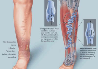 Varicose Vein Treatment Center For Advanced Cardiac And Vascular