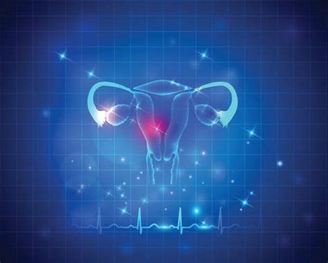 Polycystic Ovary Syndrome Pcos Illustrations Royalty Free Vector