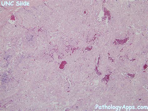 chromophobe rcc pathology