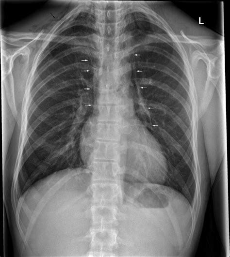 Boerhaave Syndrome Chest X Ray