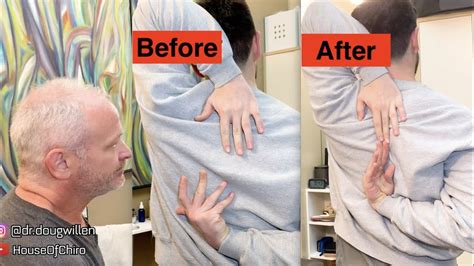 Restored Shoulder Loss Of Motion By Chiropractic Adjustment In