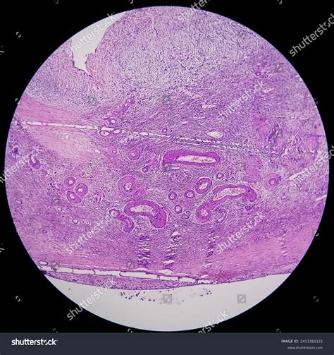 Histology, Peritoneal inclusion cyst. - Royalty Free Stock Photo ...