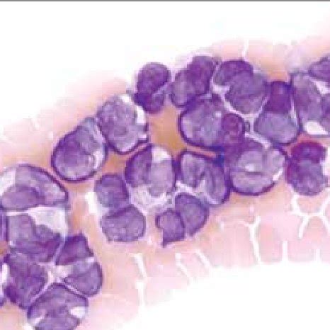 Peripheral Blood Smear Showing The Characteristic Features Of