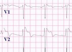 Brugada Syndrome Ecg Review Criteria And Examples Learntheheart