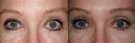 Lower Eyelid Retraction Repair Dr Guy Massry