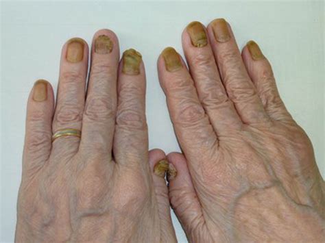 Top 182 Yellow Nail Syndrome Pleural Effusion Architectures Eric